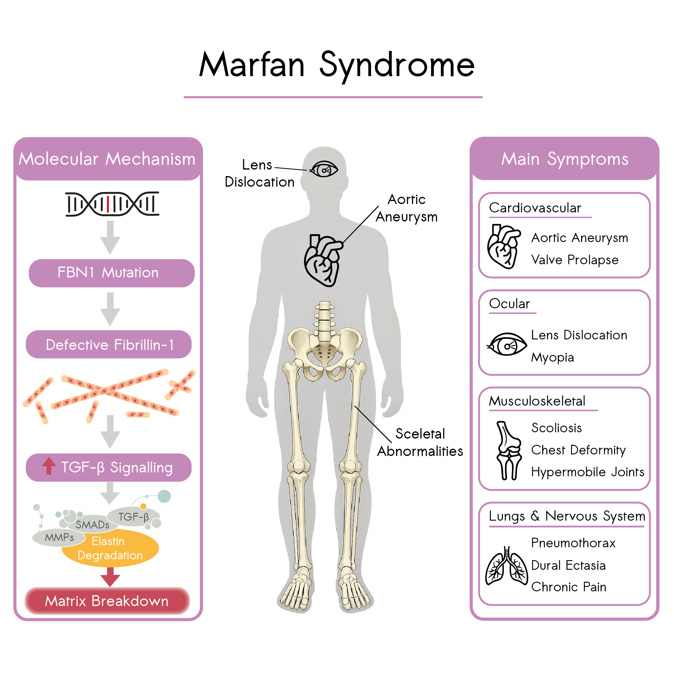 Infographic illustrating the molecular pathogenesis and systemic manifestations of Marfan syndrome, showing FBN1 mutation, defective fibrillin-1, increased TGF-β signalling, extracellular matrix degradation, and major clinical features including aortic aneurysm, lens dislocation and skeletal abnormalities.